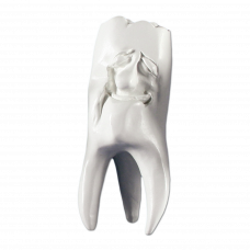 Hinrichsova sbírka zubů sádrové zuby '' Manni ''